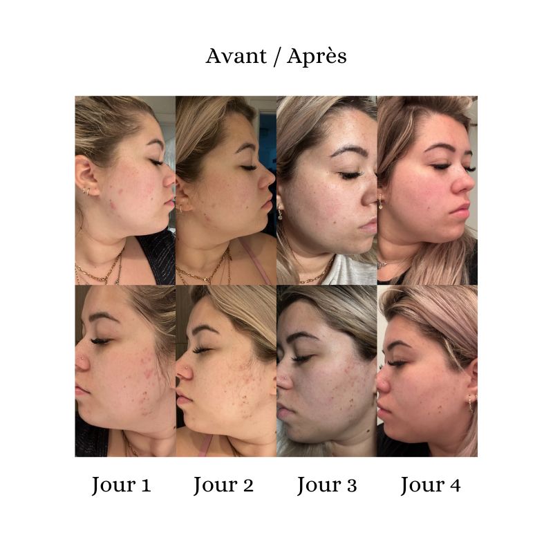 Exfoliant accélérateur 10% AHA